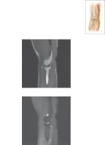 Cross Section of the Elbow: Sagittal View