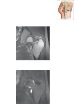 Cross Section of the Hip: Coronal View