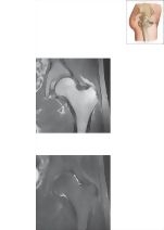 Cross Section of the Hip: Coronal View
