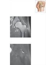 Cross Section of the Hip: Coronal View
