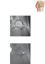 Cross Section of the Hip: Coronal View