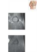 Cross Section of the Hip: Coronal View