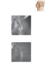 Cross Section of the Hip: Coronal Oblique View