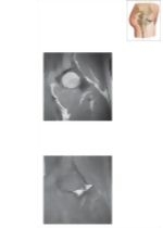 Cross Section of the Hip: Coronal Oblique View