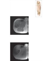 Cross Section of the Thigh: Axial View