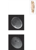 Cross Section of the Thigh: Axial View