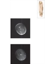 Cross Section of the Thigh: Axial View