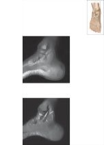Cross Section of the Ankle and Foot: Coronal View