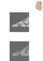 Cross Section of the Plantar Plate: Sagittal View