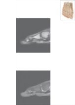 Cross Section of the Plantar Plate: Sagittal View