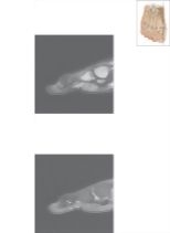 Cross Section of the Plantar Plate: Sagittal View