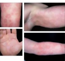 Urticaria and Acute Eczematous Dermatitis