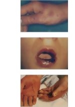 Erythema Multiforme