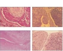 Collagen-Vascular Disease