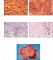 Malignant Soft Tissue Tumors