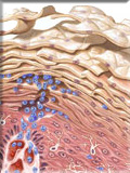 Plaque Psoriasis