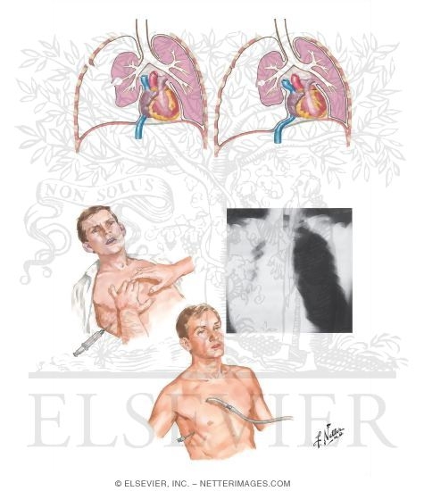 Tension Pneumothorax