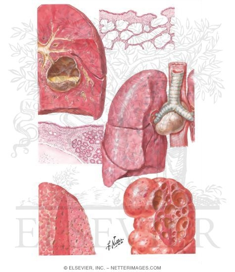 Congenital Bronchogenic and Pulmonary Cysts