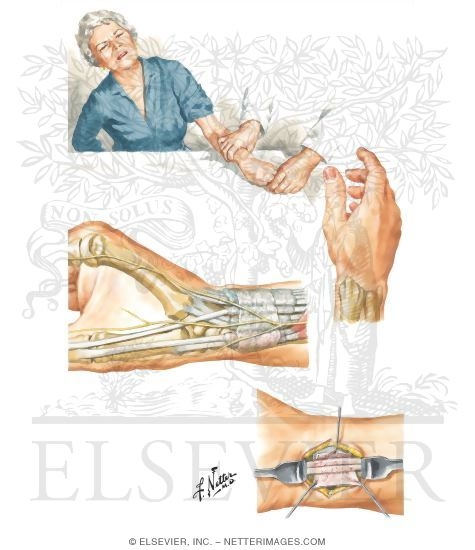 Stenosing Tenosynovitis of Abductor Pollicis Longus and Extensor Pollicis Brevis Tendons (de Quervain's Disease)
Disorders: Nerve Compression