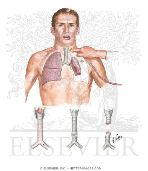 Rupture of Trachea or Major Bronchi