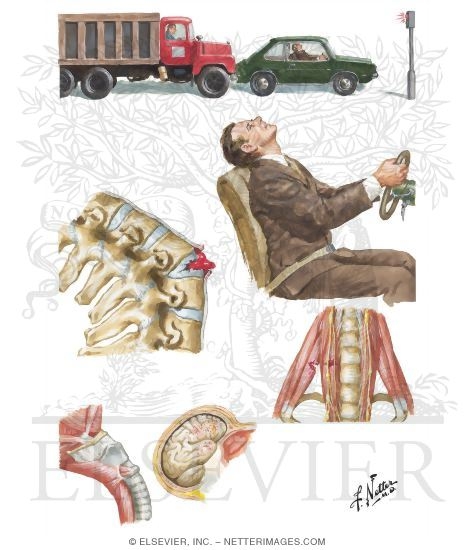 Watermarked preview of unlabeled image: Whiplash Injury