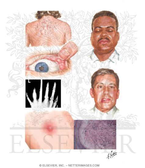Watermarked preview of unlabeled image: Sarcoidosis