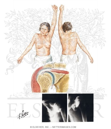 Watermarked preview of unlabeled image: Adhesive Capsulitis of Shoulder (Frozen Shoulder)