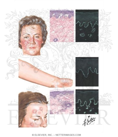 Cutaneous Lupus Band Test