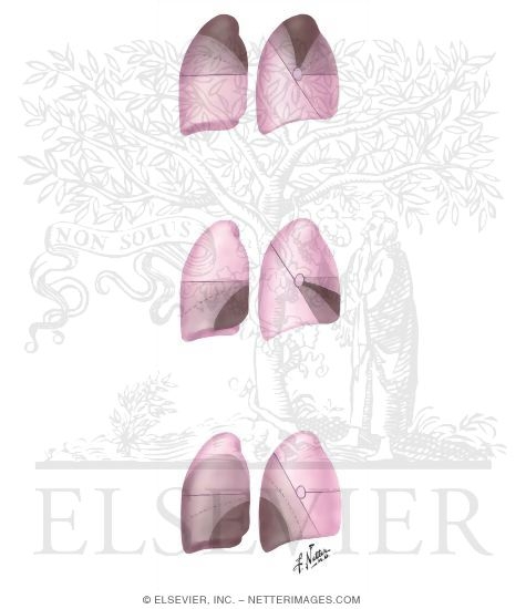 Patterns of Lobar Collapse; Right Lung (after Lubert and Krause)