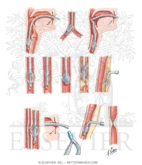 Watermarked preview of unlabeled image: Morbidity of Endotracheal Intubation and Tracheostomy