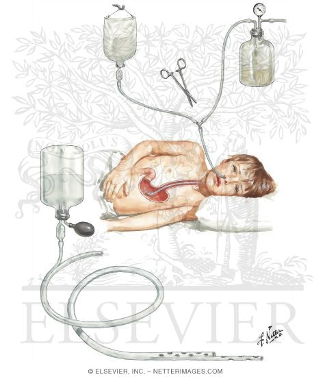 Watermarked preview of unlabeled image: Gastric Lavage: Specialized Equipment