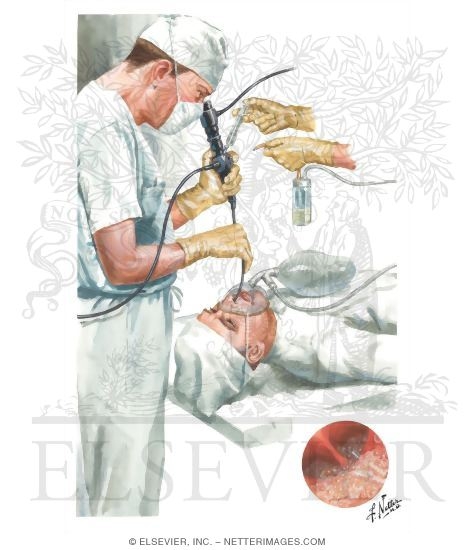 Watermarked preview of unlabeled image: Bronchofiberscopic Suction and Lavage