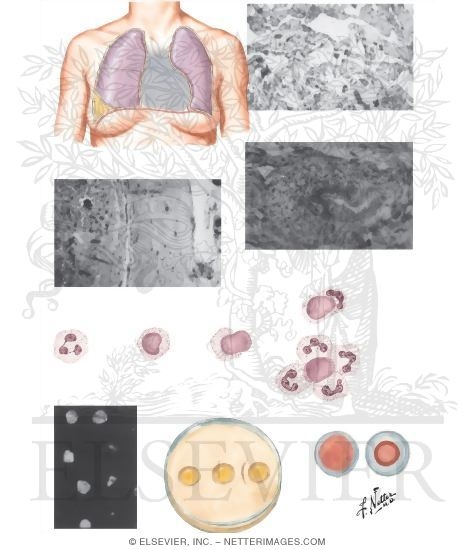 icd 10 code for systemic lupus erythematosus with lung involvement