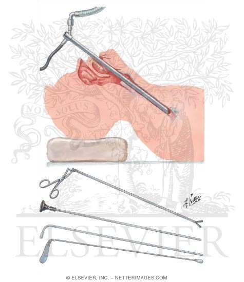 Flexible Bronchoscopy