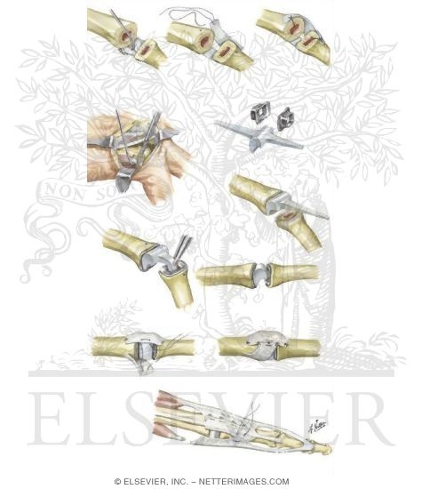 Watermarked preview of unlabeled image: Implant Resection Arthroplasty for Metacarpophalangeal Joints (Continued)