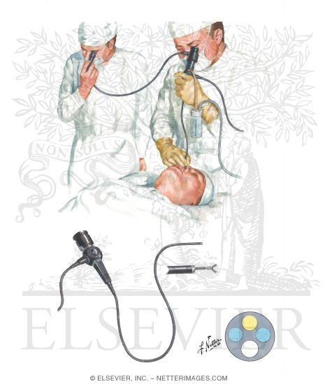 Watermarked preview of unlabeled image: Bronchofiberscopy