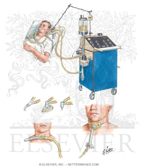 Watermarked preview of unlabeled image: Mechanical Ventilation