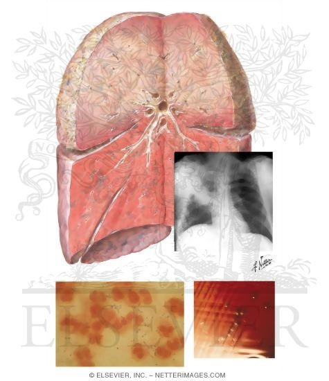 Pneumococcal Pneumonia