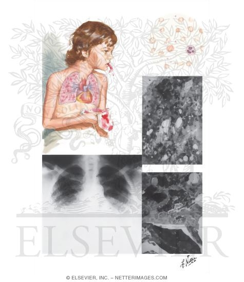Idiopathic Pulmonary Hemosiderosis