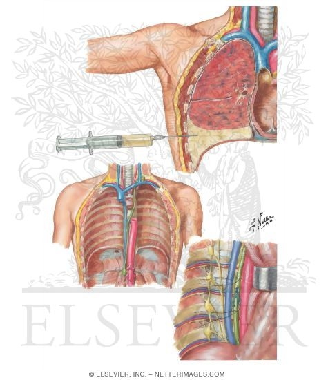 Chylothorax