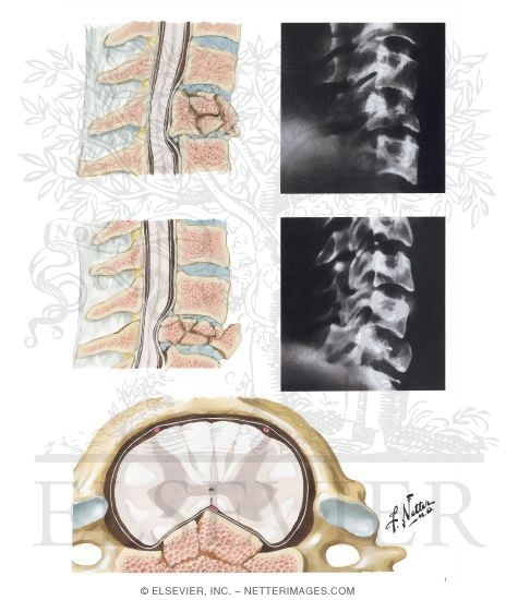 Compression Fractures of Cervical Spine
