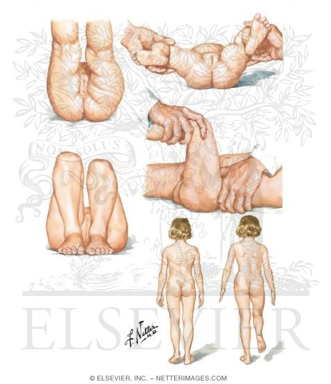 Watermarked preview of unlabeled image: Clinical Findings in CDH