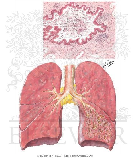 Bronchiectasis