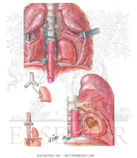 Bronchopulmonary Sequestration