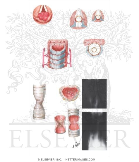 Laryngeal Granuloma and Tracheal Stenosis