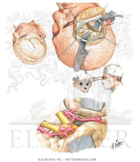 Frontotemporal Approach for Internal Cartoid, Ophthalmic, Anterior Communicating, and Anterior and Middle Cerebral Aneurysms