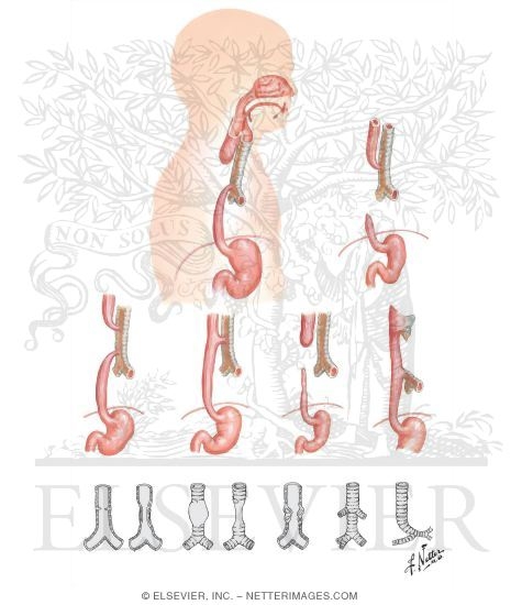 Tracheoesophageal Fistula
