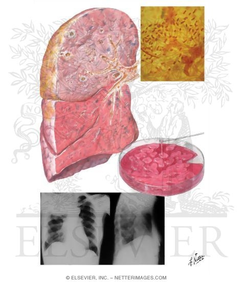 Klebsiella (Friedlander's) Pneumonia