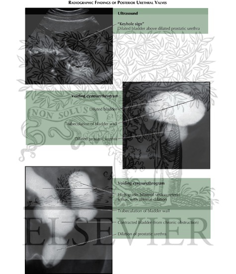 Watermarked preview of unlabeled image: Posterior Urethral Valves: Radiographic Findings