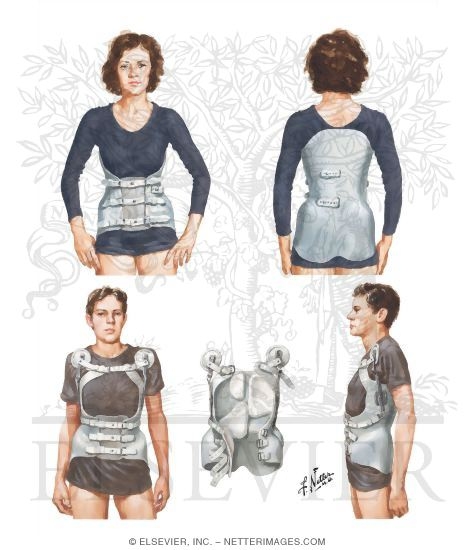 Watermarked preview of unlabeled image: New York Orthopaedic Hospital Low-Profile Brace